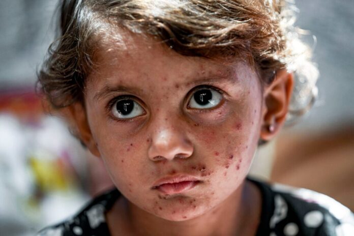 Gaza’s children suffer as conflict fuels severe skin diseases